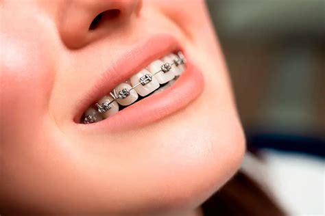 precio de brackets metalicos en argentina|brackets de zafiro precio.